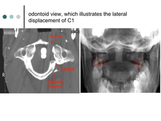 odontoid view, which illustrates the lateral
displacement of C1
 