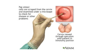 cervical screening and cervical procedure .pptx