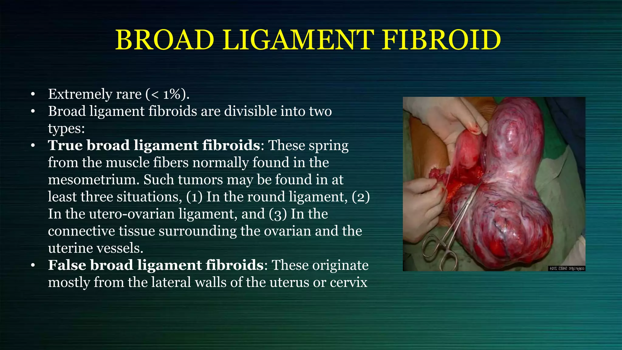 BROAD LIGAMENT FIBROID
• Extremely rare (< 1%).
• Broad ligament fibroids are divisible into two
types:
• True broad ligament fibroids: These spring
from the muscle fibers normally found in the
mesometrium. Such tumors may be found in at
least three situations, (1) In the round ligament, (2)
In the utero-ovarian ligament, and (3) In the
connective tissue surrounding the ovarian and the
uterine vessels.
• False broad ligament fibroids: These originate
mostly from the lateral walls of the uterus or cervix
 