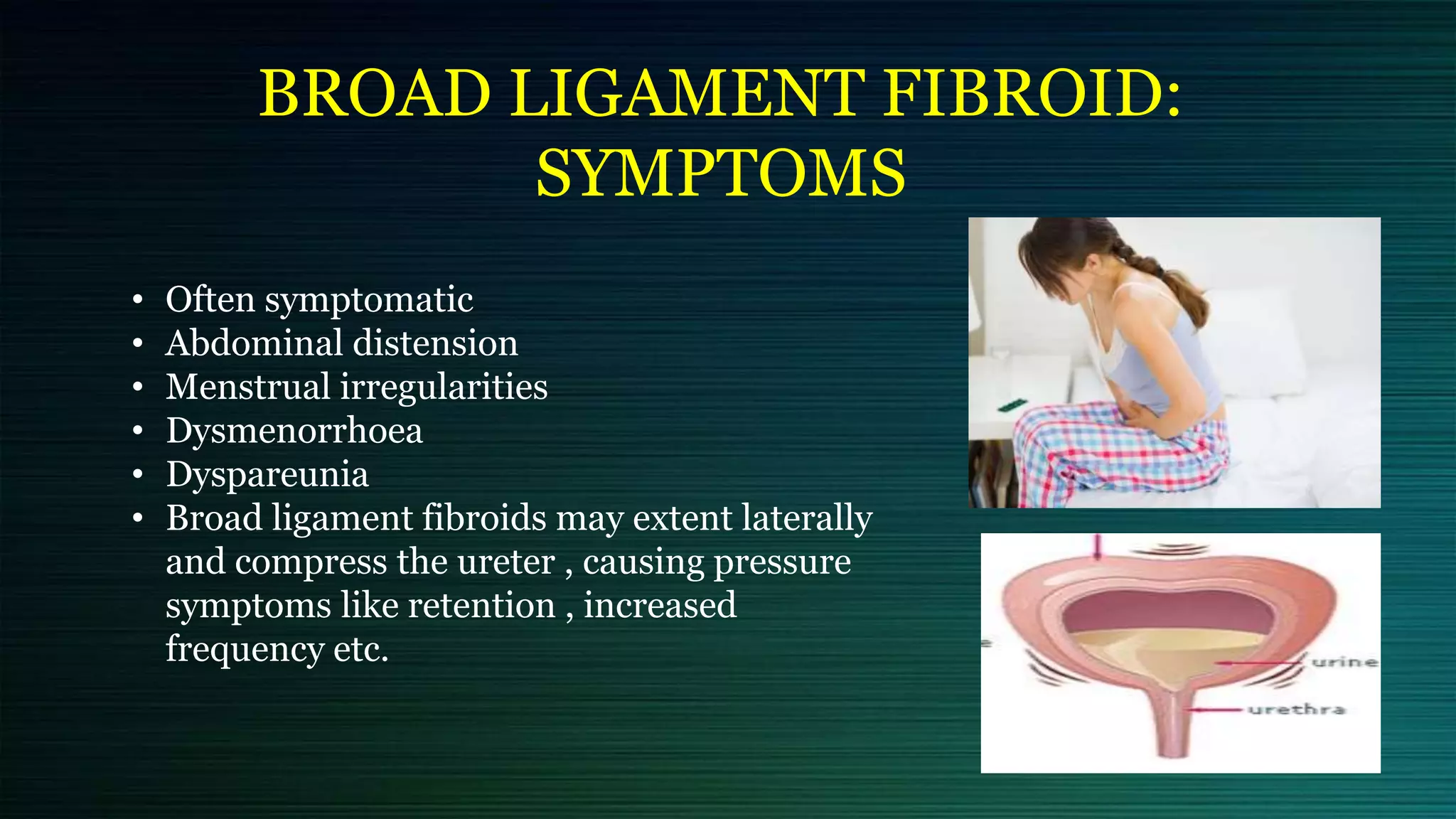 BROAD LIGAMENT FIBROID:
SYMPTOMS
• Often symptomatic
• Abdominal distension
• Menstrual irregularities
• Dysmenorrhoea
• Dyspareunia
• Broad ligament fibroids may extent laterally
and compress the ureter , causing pressure
symptoms like retention , increased
frequency etc.
 