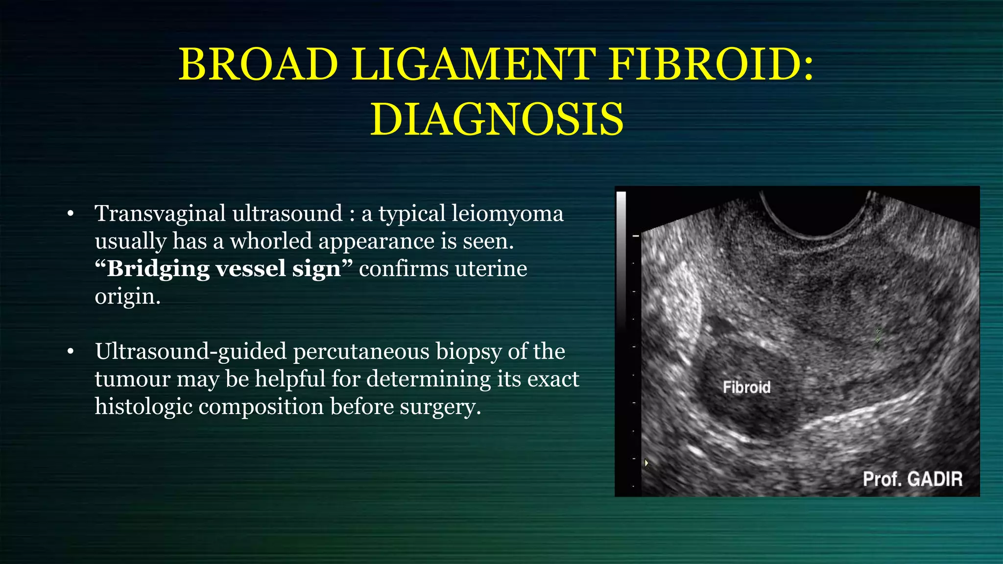 BROAD LIGAMENT FIBROID:
DIAGNOSIS
• Transvaginal ultrasound : a typical leiomyoma
usually has a whorled appearance is seen.
“Bridging vessel sign” confirms uterine
origin.
• Ultrasound-guided percutaneous biopsy of the
tumour may be helpful for determining its exact
histologic composition before surgery.
 
