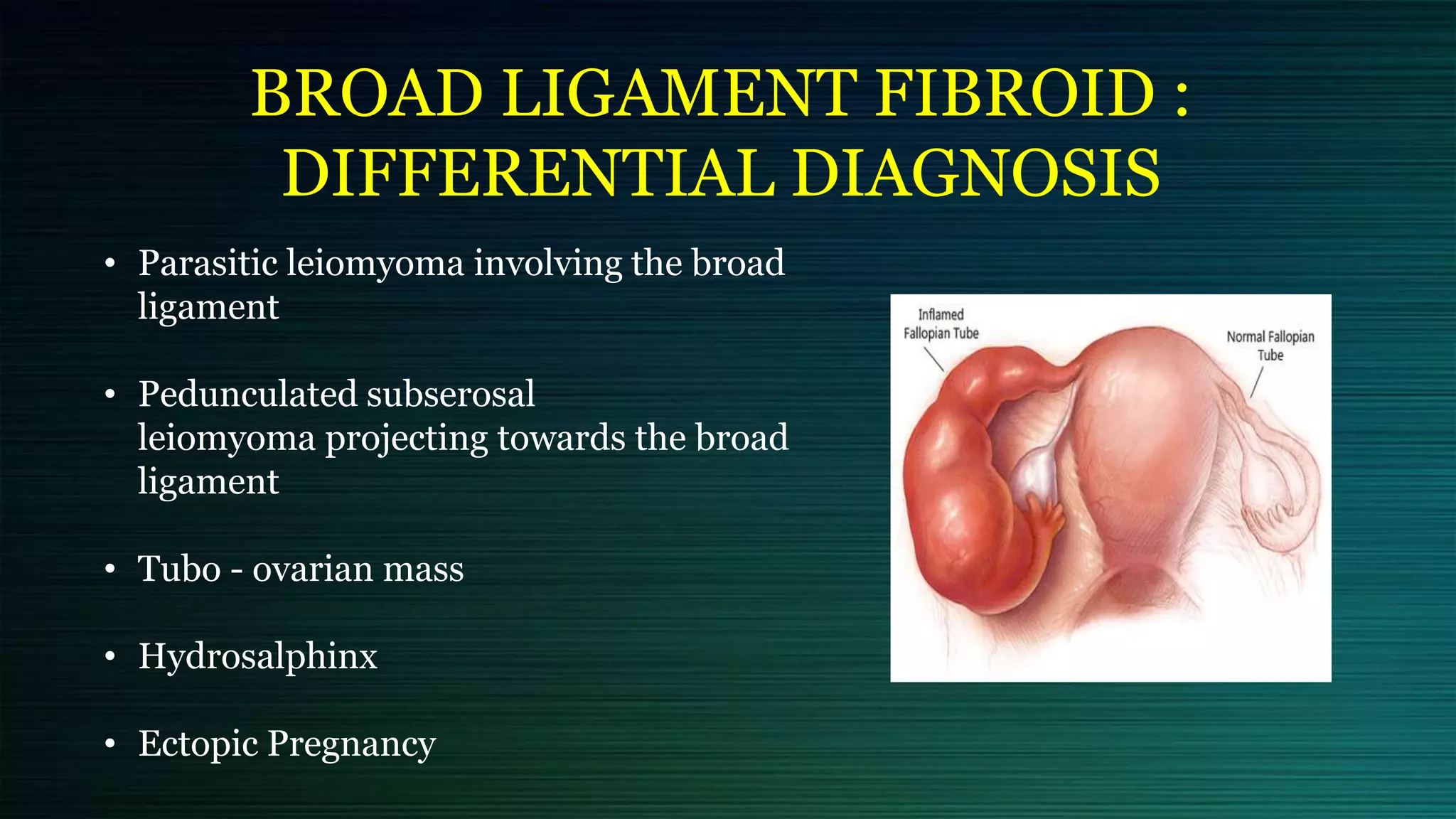BROAD LIGAMENT FIBROID :
DIFFERENTIAL DIAGNOSIS
• Parasitic leiomyoma involving the broad
ligament
• Pedunculated subserosal
leiomyoma projecting towards the broad
ligament
• Tubo - ovarian mass
• Hydrosalphinx
• Ectopic Pregnancy
 