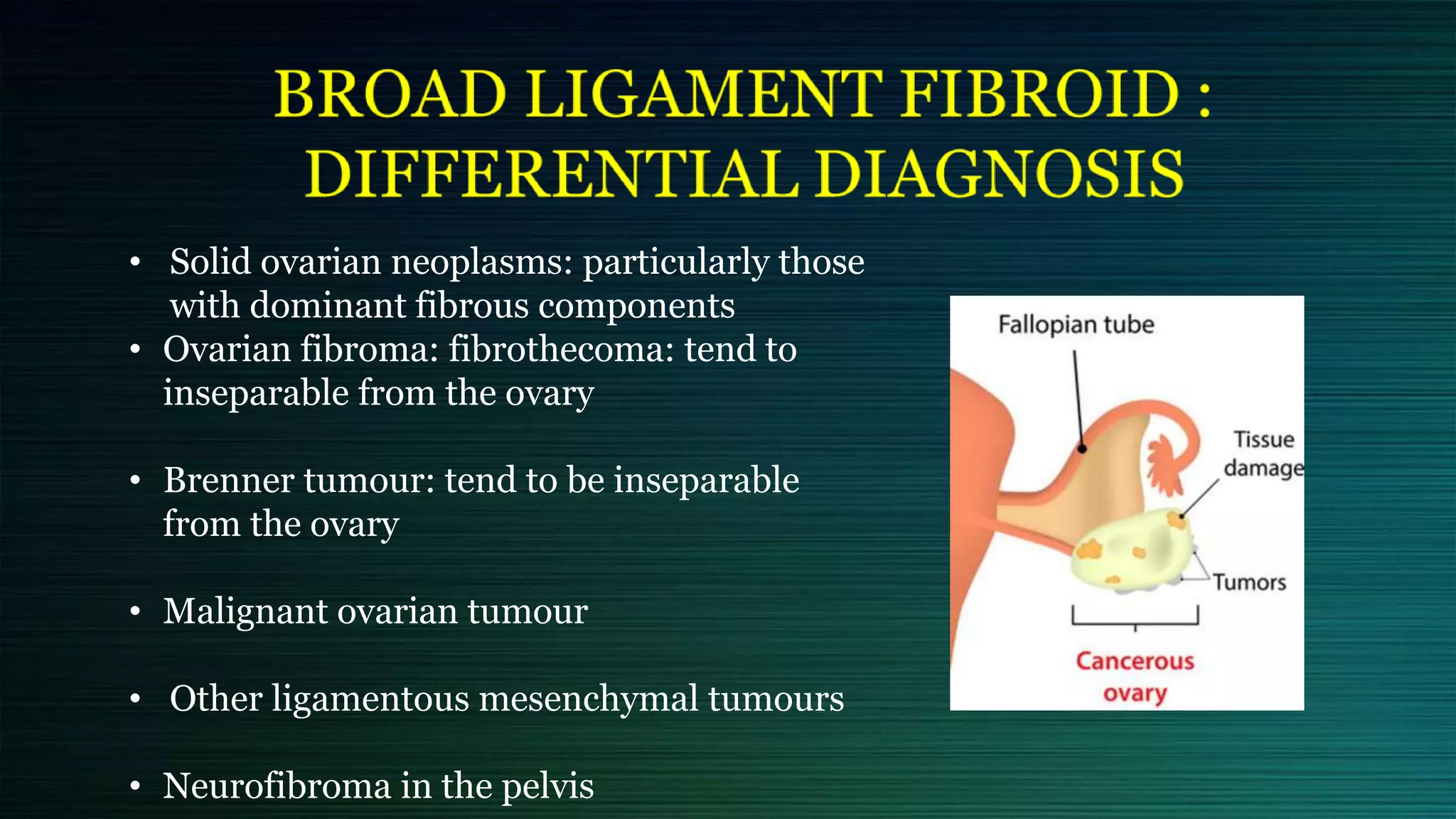 • Solid ovarian neoplasms: particularly those
with dominant fibrous components
• Ovarian fibroma: fibrothecoma: tend to
inseparable from the ovary
• Brenner tumour: tend to be inseparable
from the ovary
• Malignant ovarian tumour
• Other ligamentous mesenchymal tumours
• Neurofibroma in the pelvis
 
