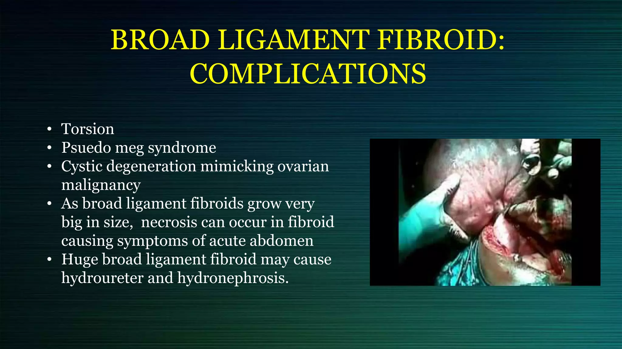 BROAD LIGAMENT FIBROID:
COMPLICATIONS
• Torsion
• Psuedo meg syndrome
• Cystic degeneration mimicking ovarian
malignancy
• As broad ligament fibroids grow very
big in size, necrosis can occur in fibroid
causing symptoms of acute abdomen
• Huge broad ligament fibroid may cause
hydroureter and hydronephrosis.
 