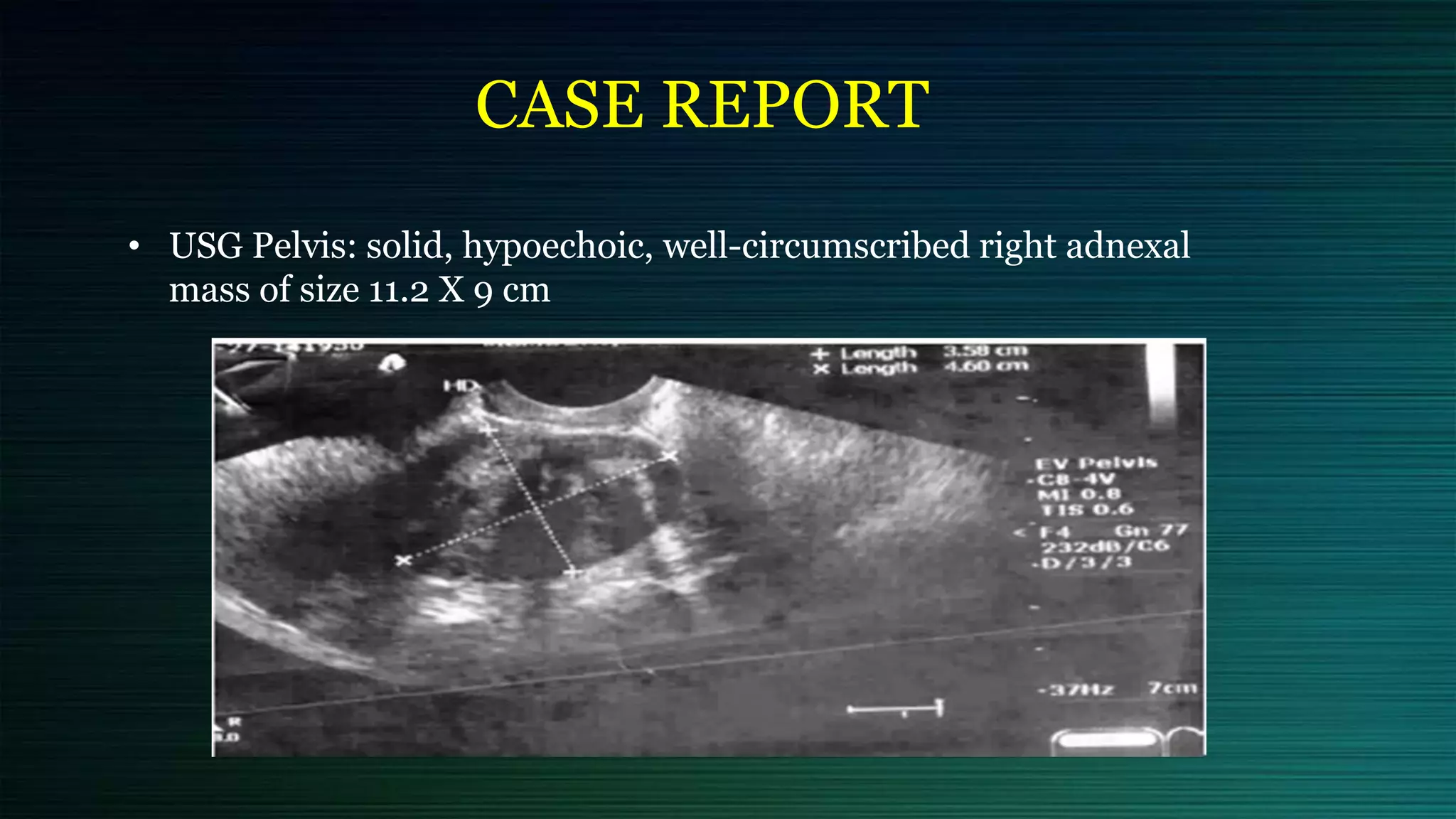 CASE REPORT
• USG Pelvis: solid, hypoechoic, well-circumscribed right adnexal
mass of size 11.2 X 9 cm
 