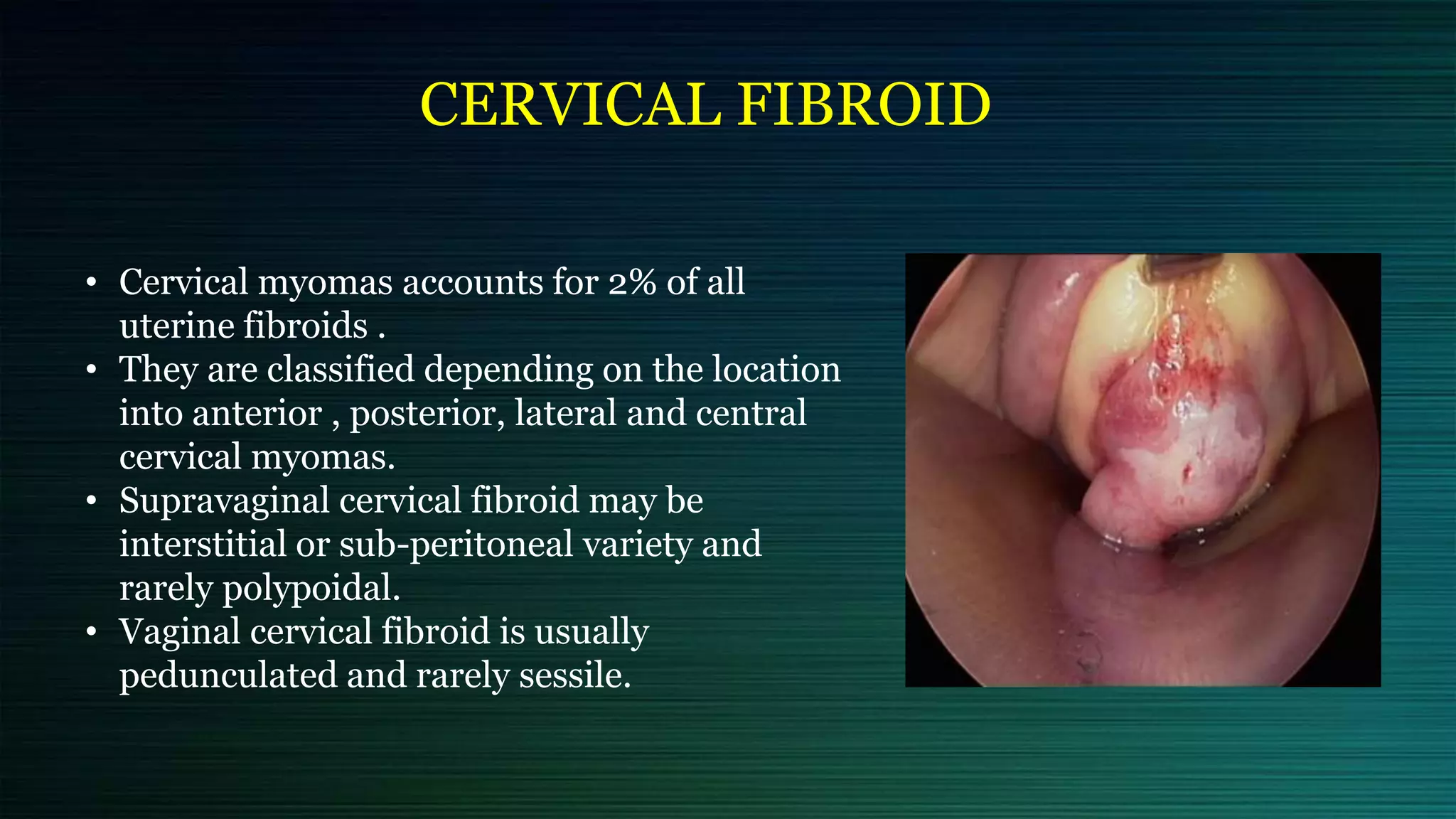 CERVICAL FIBROID
• Cervical myomas accounts for 2% of all
uterine fibroids .
• They are classified depending on the location
into anterior , posterior, lateral and central
cervical myomas.
• Supravaginal cervical fibroid may be
interstitial or sub-peritoneal variety and
rarely polypoidal.
• Vaginal cervical fibroid is usually
pedunculated and rarely sessile.
 