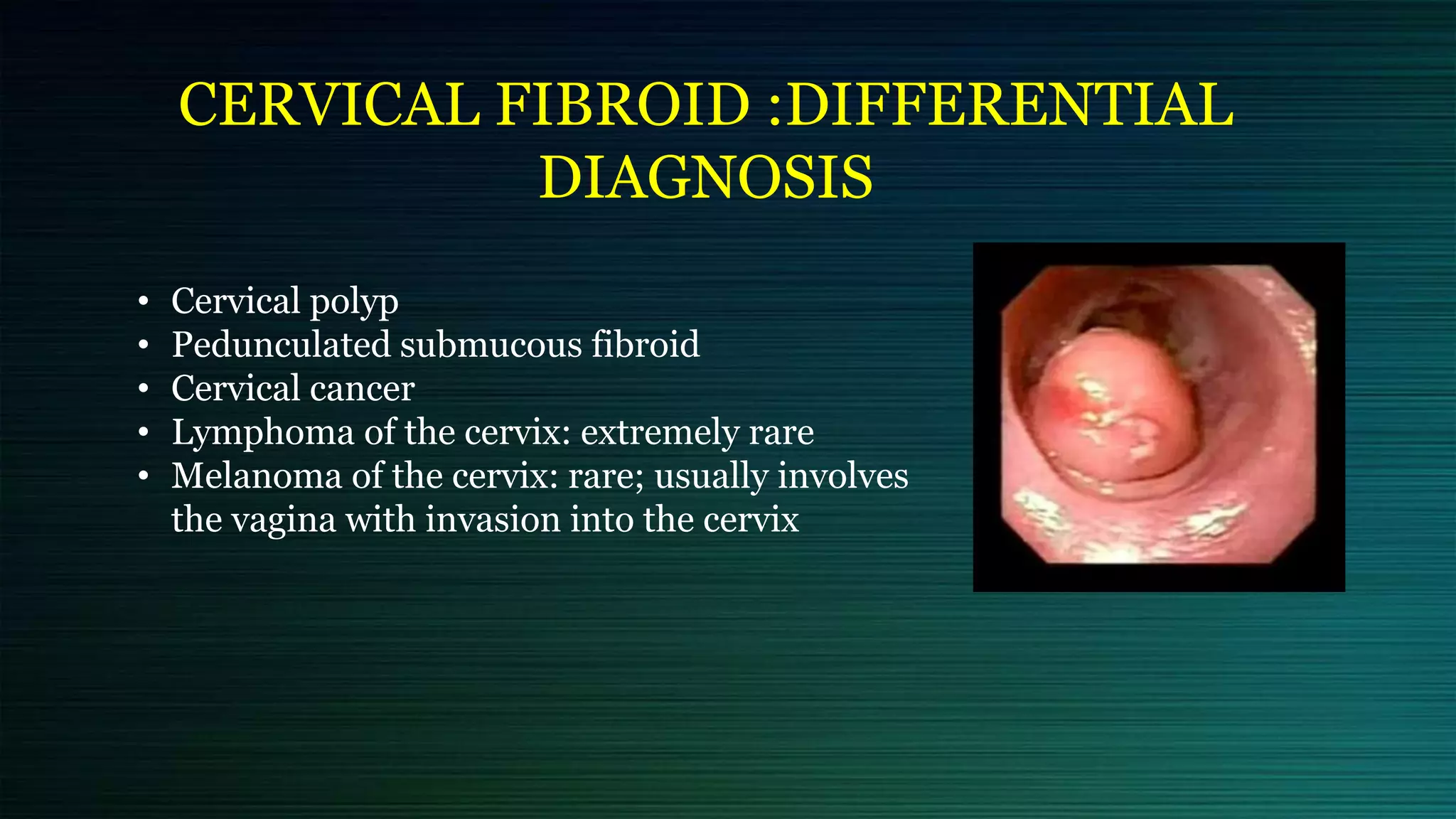 CERVICAL FIBROID :DIFFERENTIAL
DIAGNOSIS
• Cervical polyp
• Pedunculated submucous fibroid
• Cervical cancer
• Lymphoma of the cervix: extremely rare
• Melanoma of the cervix: rare; usually involves
the vagina with invasion into the cervix
 