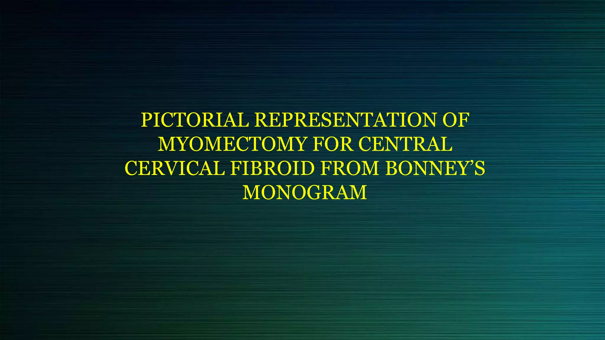 PICTORIAL REPRESENTATION OF
MYOMECTOMY FOR CENTRAL
CERVICAL FIBROID FROM BONNEY’S
MONOGRAM
 