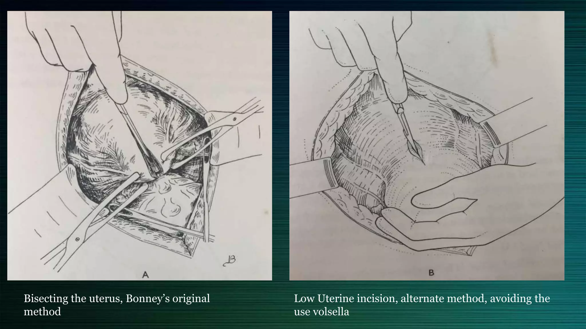 Bisecting the uterus, Bonney’s original
method
Low Uterine incision, alternate method, avoiding the
use volsella
 