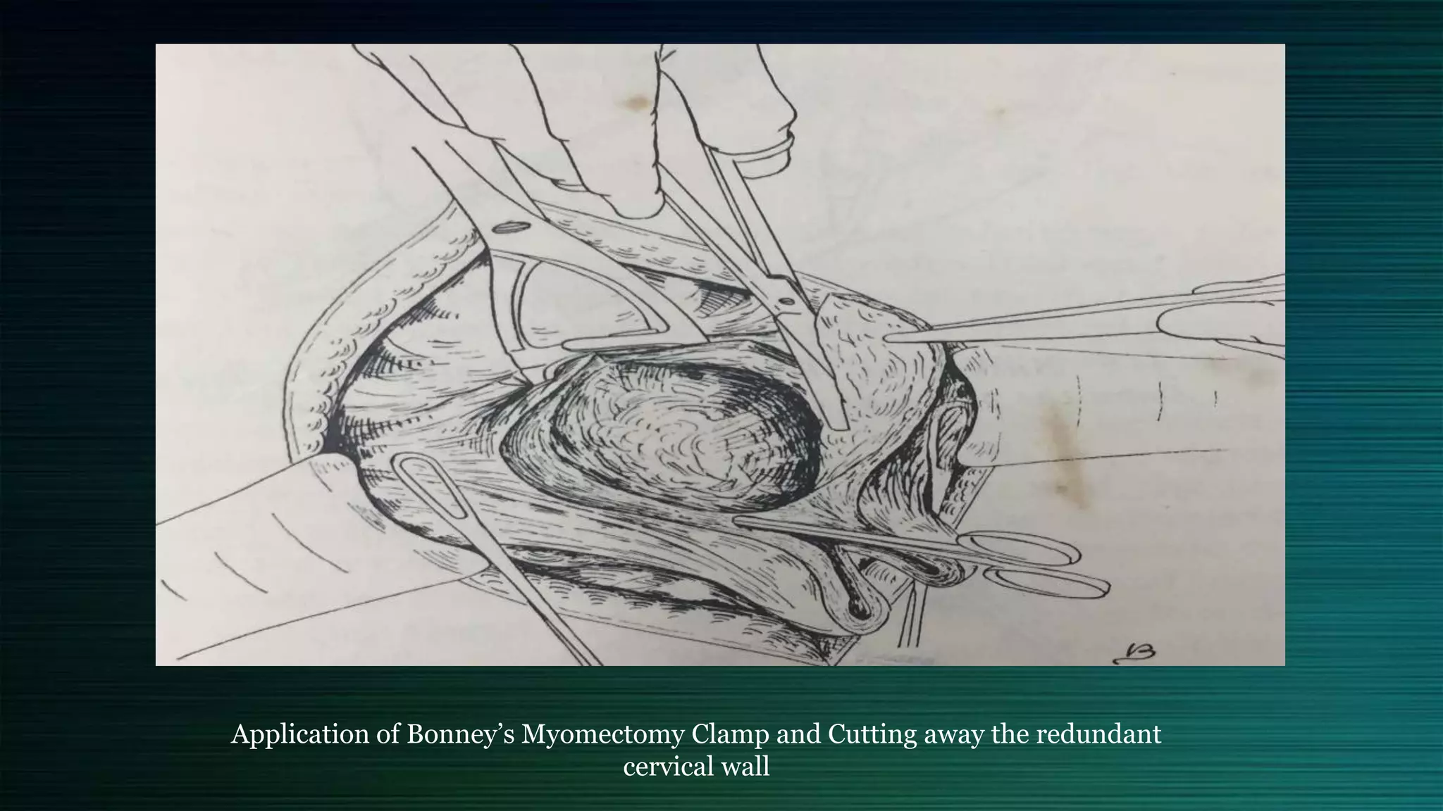 Application of Bonney’s Myomectomy Clamp and Cutting away the redundant
cervical wall
 