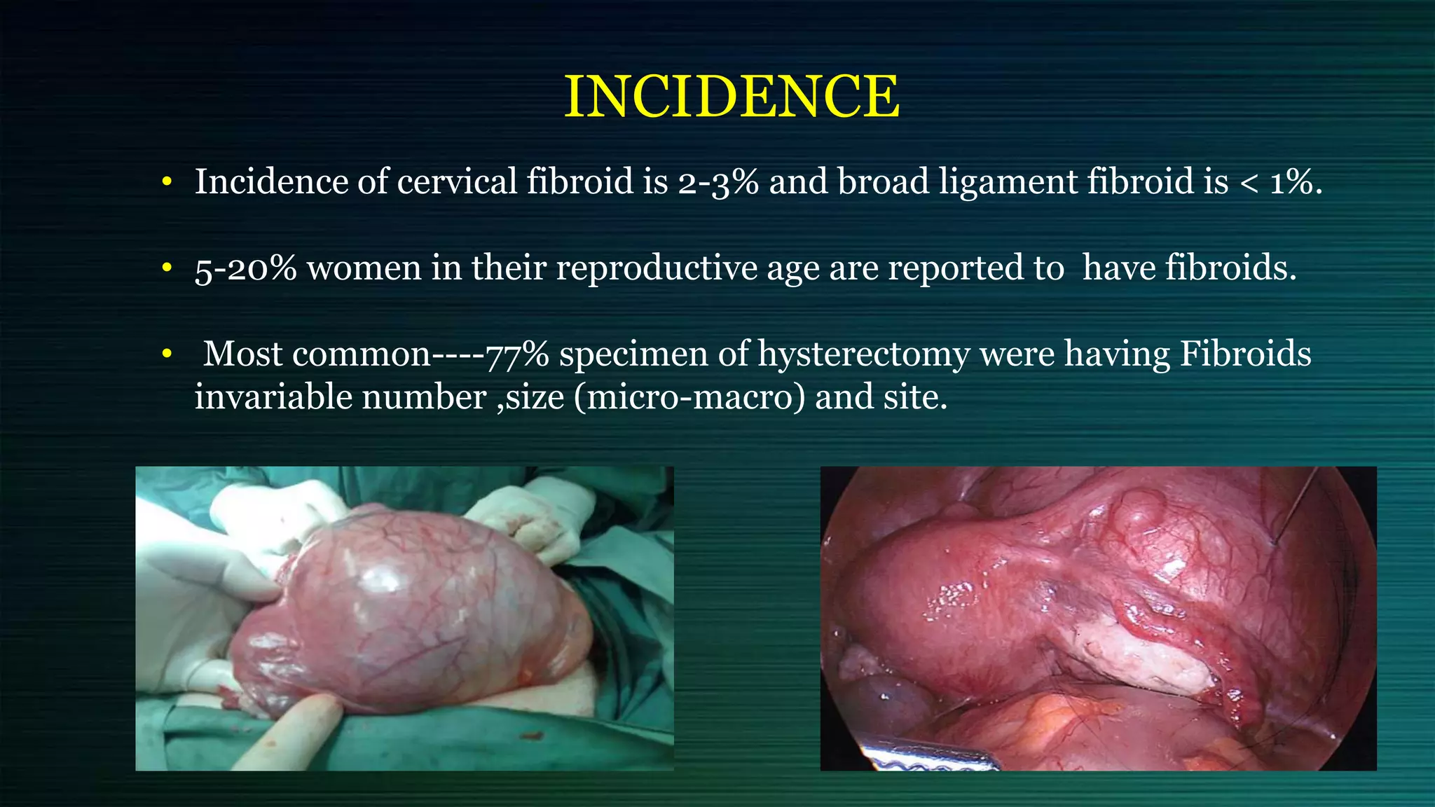 INCIDENCE
• Incidence of cervical fibroid is 2-3% and broad ligament fibroid is < 1%.
• 5-20% women in their reproductive age are reported to have fibroids.
• Most common----77% specimen of hysterectomy were having Fibroids
invariable number ,size (micro-macro) and site.
 