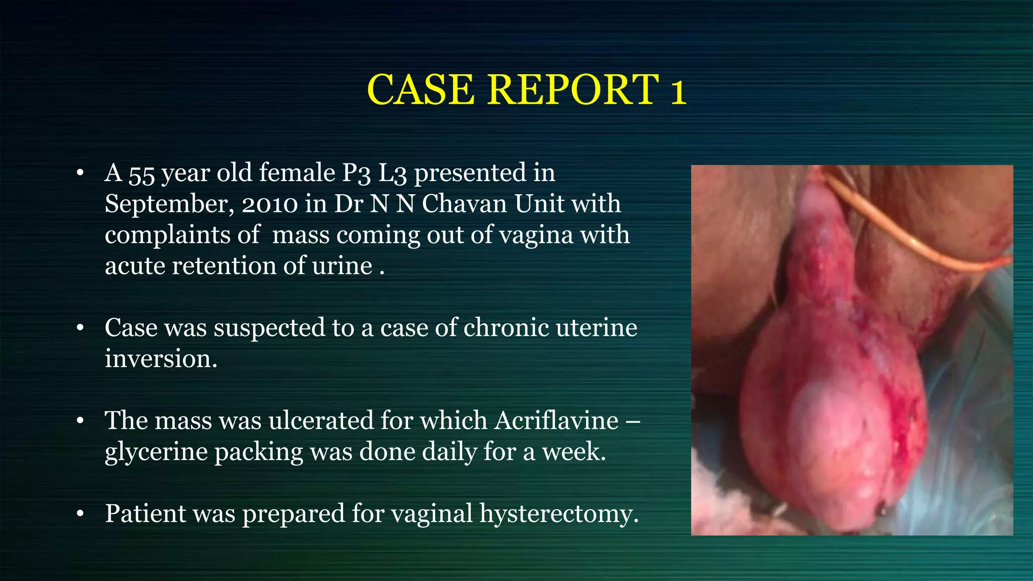 • A 55 year old female P3 L3 presented in
September, 2010 in Dr N N Chavan Unit with
complaints of mass coming out of vagina with
acute retention of urine .
• Case was suspected to a case of chronic uterine
inversion.
• The mass was ulcerated for which Acriflavine –
glycerine packing was done daily for a week.
• Patient was prepared for vaginal hysterectomy.
CASE REPORT 1
 
