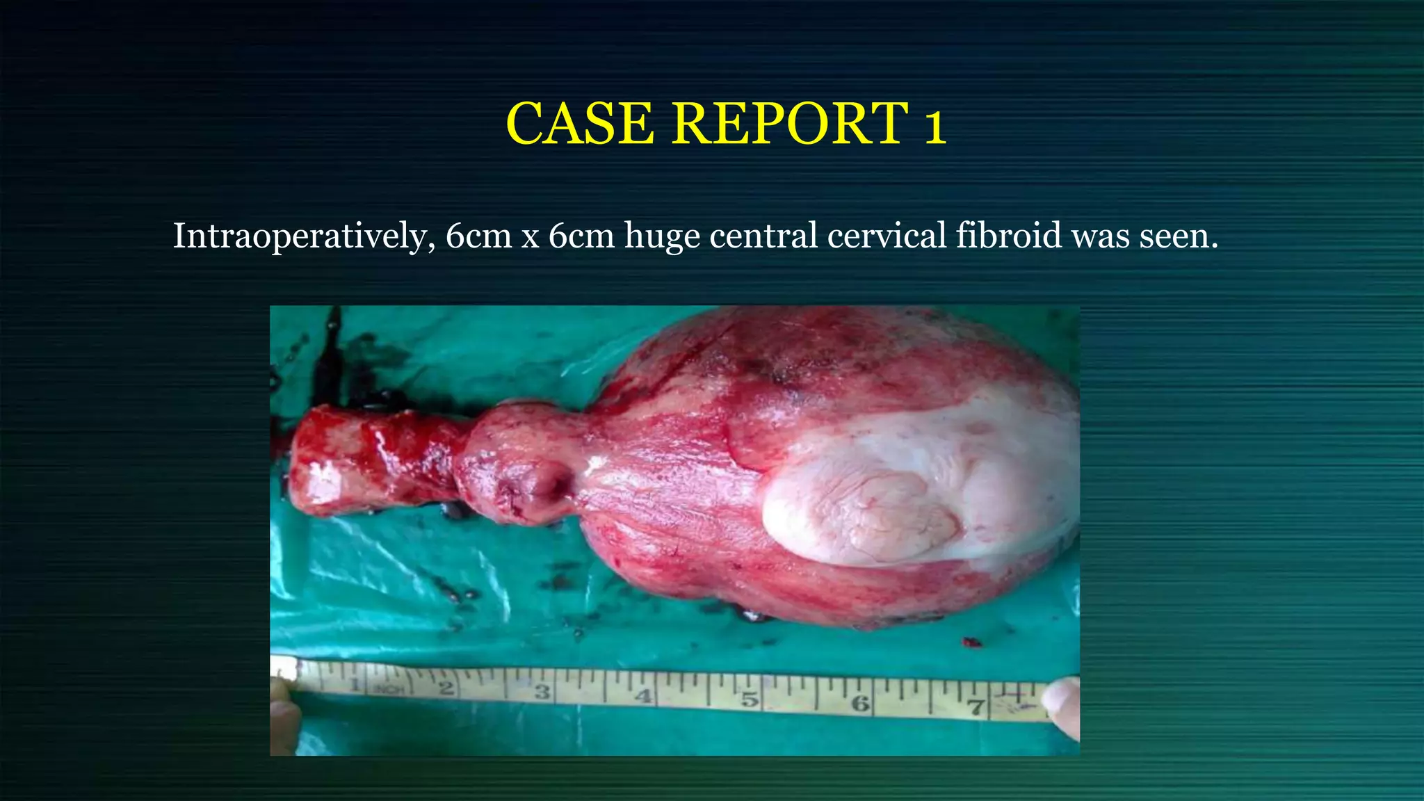 CASE REPORT 1
Intraoperatively, 6cm x 6cm huge central cervical fibroid was seen.
 