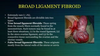 Cervical and broad ligament fibroid