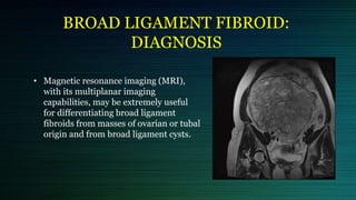 Cervical and broad ligament fibroid