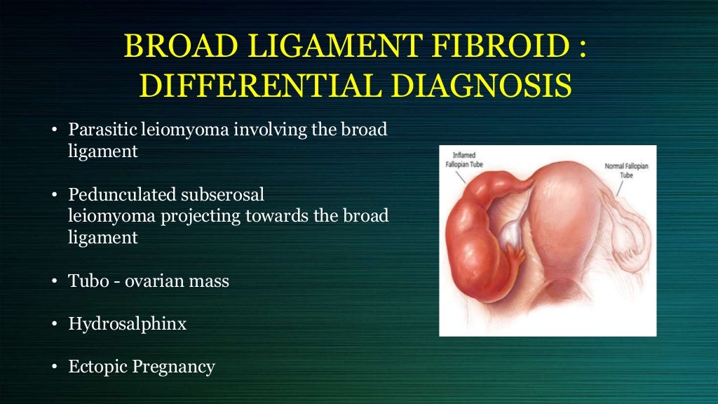 Cervical and broad ligament fibroid