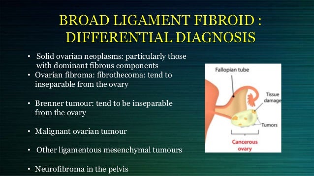 cervical and broad ligament fibroid