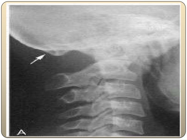 Congenital anomalies and Normal skeletal variants- Cervical spine