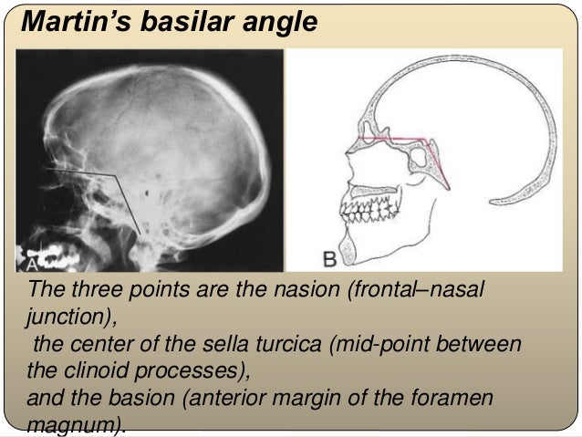 Skull Base Angle – Normative Measurements of the Skull Base on Imaging ...