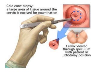 Cervical Biopsy - Obstetrics & Gynaecology