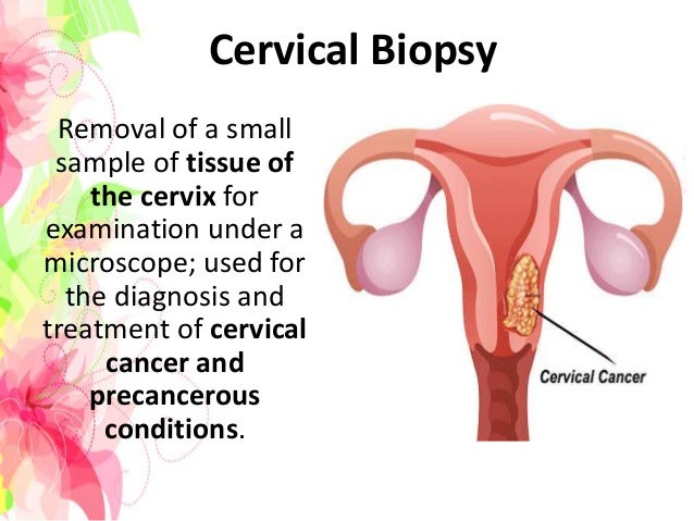 Featured image of post Steps to Prepare Punch Biopsy Cervix Infection