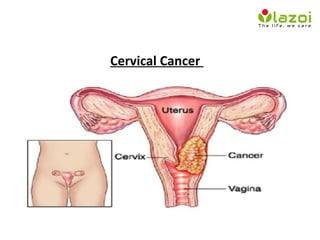 Cervical Cancer
 