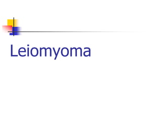 Leiomyoma
 