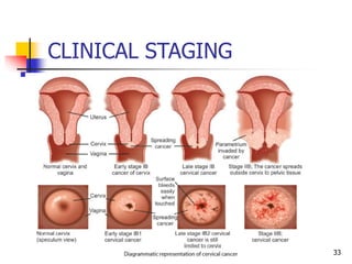 CLINICAL STAGING
33
 