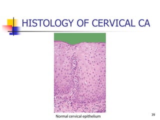 HISTOLOGY OF CERVICAL CA
39
 