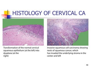 HISTOLOGY OF CERVICAL CA
40
 