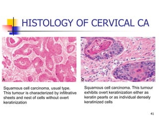 HISTOLOGY OF CERVICAL CA
41
Squamous cell carcinoma, usual type.
This tumour is characterized by infiltrative
sheets and nest of cells without overt
keratinization
Squamous cell carcinoma. This tumour
exhibits overt keratinization either as
keratin pearls or as individual densely
keratinized cells
 