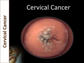 Cervical CancerCervicalCancer
 