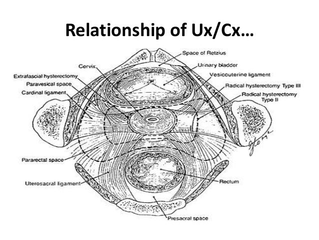 Cervical cancer, Anatomy and pathology