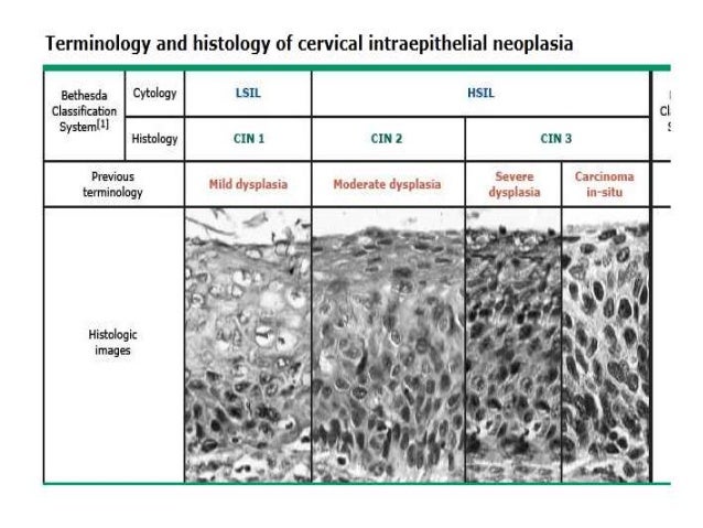 Cervical cancer, Anatomy and pathology