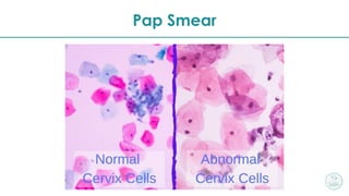 Smear Example CERVICAL CANCER | PDF