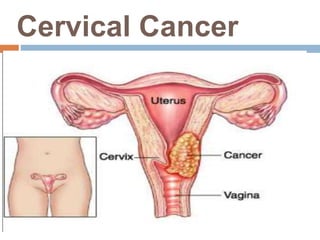 Cervical Cancer
 