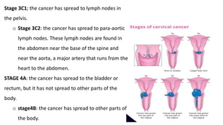 Stage 3C1; the cancer has spread to lymph nodes in
the pelvis.
o Stage 3C2: the cancer has spread to para-aortic
lymph nodes. These lymph nodes are found in
the abdomen near the base of the spine and
near the aorta, a major artery that runs from the
heart to the abdomen.
STAGE 4A: the cancer has spread to the bladder or
rectum, but it has not spread to other parts of the
body.
o stage4B: the cancer has spread to other parts of
the body.
 