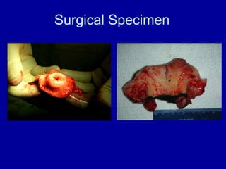 Surgical Specimen 