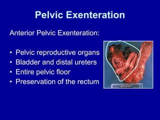 Pelvic Exenteration Anterior Pelvic Exenteration: Pelvic reproductive organs Bladder and distal ureters Entire pelvic floor Preservation of the rectum 