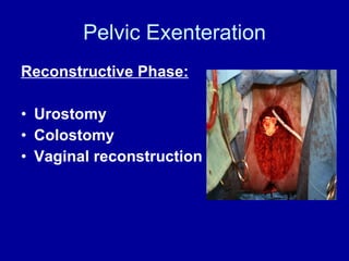 Pelvic Exenteration Reconstructive Phase: Urostomy Colostomy Vaginal reconstruction 