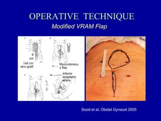 OPERATIVE  TECHNIQUE Modified VRAM Flap Sood et al, Obstet Gynecol 2005 8 cm 1x6 cm skin graft Inferior epigastric artery Myocutaneous flap 