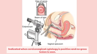 Indicated when cervicovaginal cytology is positive and no gross
lesion is seen.
 