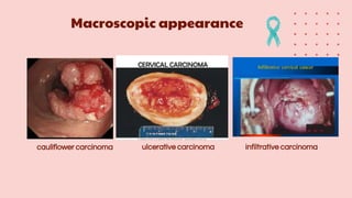 Macroscopic appearance
cauliflower carcinoma ulcerative carcinoma infiltrative carcinoma
 