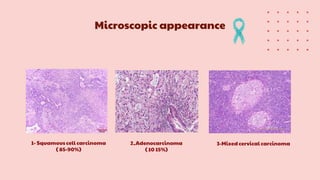 Microscopic appearance
1- Squamous cell carcinoma
( 85-90%)
2_Adenocarcinoma
( 10 15%)
3-Mixed cervical carcinoma
 
