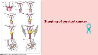 Staging of cervical cancer
 