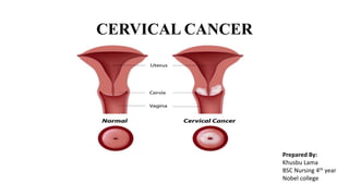 CERVICAL CANCER
Prepared By:
Khusbu Lama
BSC Nursing 4th year
Nobel college
 