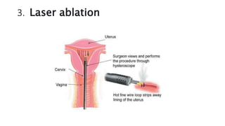 3. Laser ablation
 