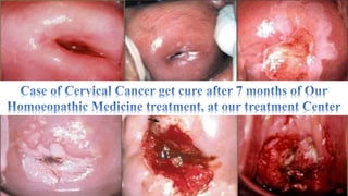 Cervical cancer & Homoeopathy