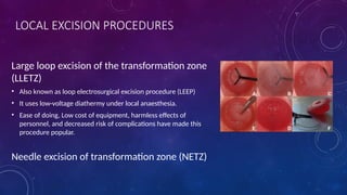 Leetz Comprehensive Guide to Cervical Cancer Prevention and Screening Methods ...