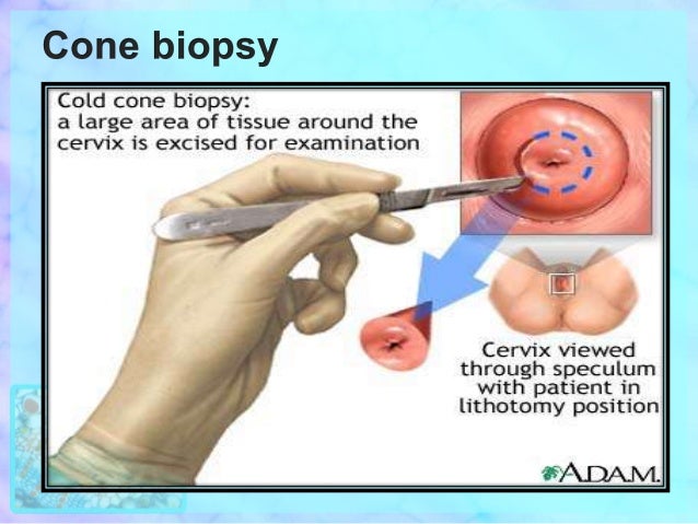 research paper on cervical cancer